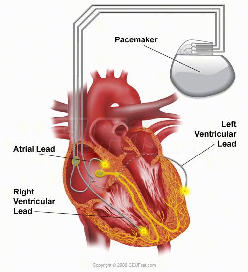 pacemaker-ct